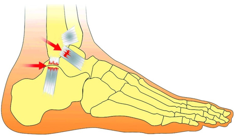 Bei zu starker Überdehnung können die Bänder im Fußgelenk reißen (Foto: Rehband).
