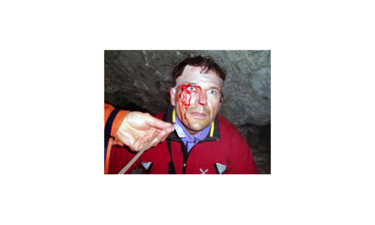 Gesichtsverletzung beim Eisklettern. In diesem Fall wurde mit 4 Stichen genäht. Foto mit freundlicher Genehmigung von www.bergsteigen.at.