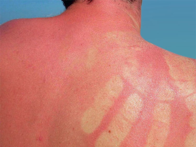 Sonnenbrand: Schlecht für die Haut und auch noch sehr unangenehm.
